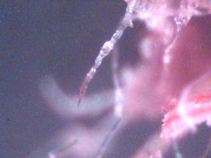 morgellons disease symptoms